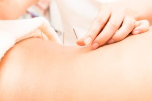 acupuncture Melbourne