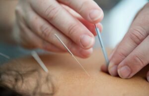 acupuncture Toorak